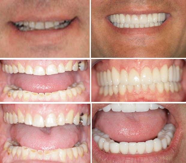 before and after teeth for cosmetic dentistry